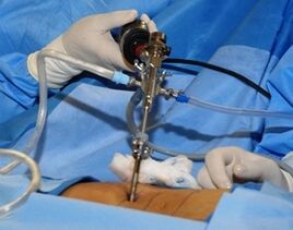 Surgical treatment of lumbar osteochondrosis