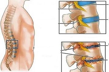 The reasons for the development of lumbar osteochondrosis
