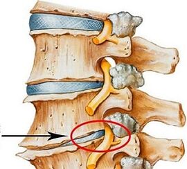 Why is lumbar osteochondrosis