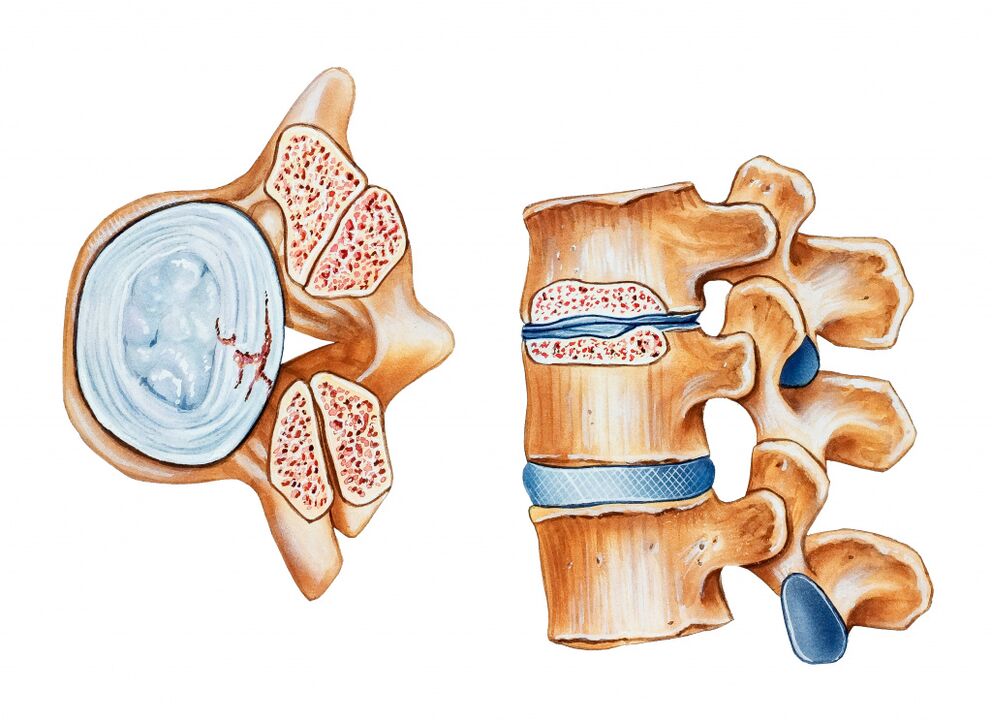 osteochondrosis of the cervical region leads to the destruction of the intervertebral discs