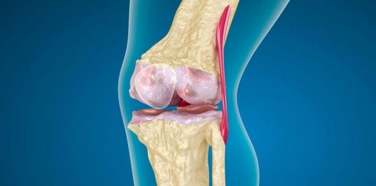 Damage to the knee joint for arthrosis