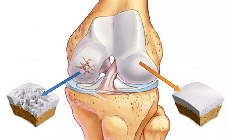 Healthy cartilage and arthrosis of the joint