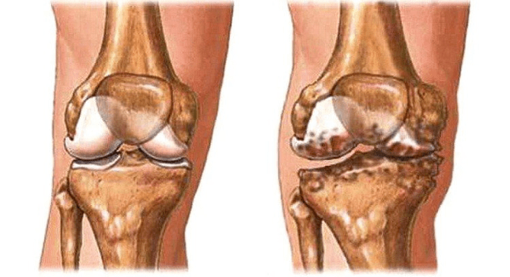 Healthy joint and arthrosis of the knee joint