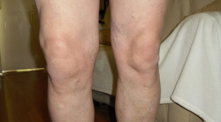 manifestations of arthrosis of the knee joint
