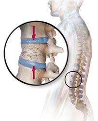 Osteoporosis provokes back pain in the lower back