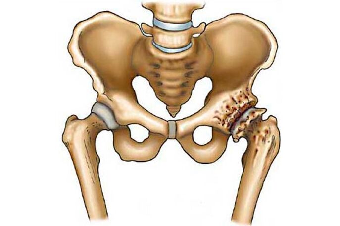 arthrosis of the hip joint